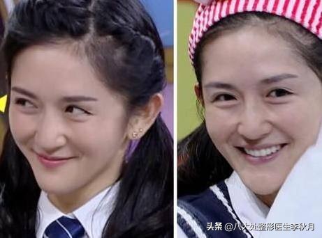 眼部细纹和眼袋泪沟怎么去除,赶走泪沟眼袋眼干没细纹