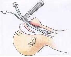 19岁女孩做隆鼻手术8小时内死亡,29岁女生隆鼻死亡真相调查