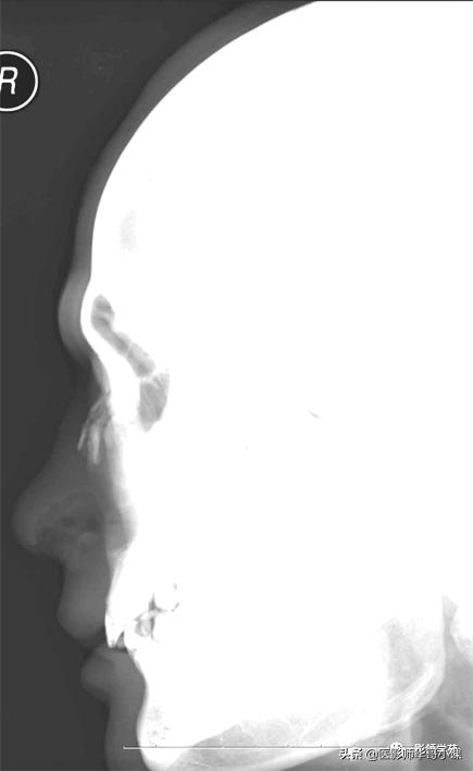 「鼻骨彩图」鼻骨CT解剖及骨折影像学诊断