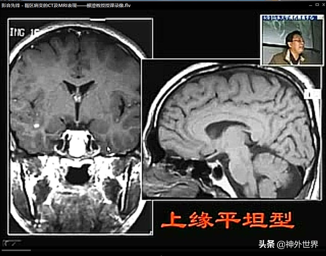 鞍区解剖学习笔记之——垂体
