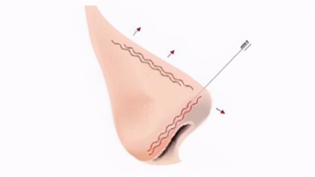 2022年流行鼻整形的全过程视频,大宽鼻手术案例