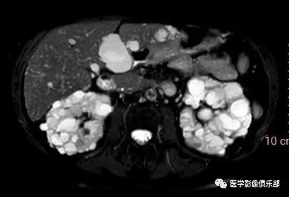 双肾多发小囊肿到底是不是多囊肾,肾多发囊肿与多囊肾的超声鉴别