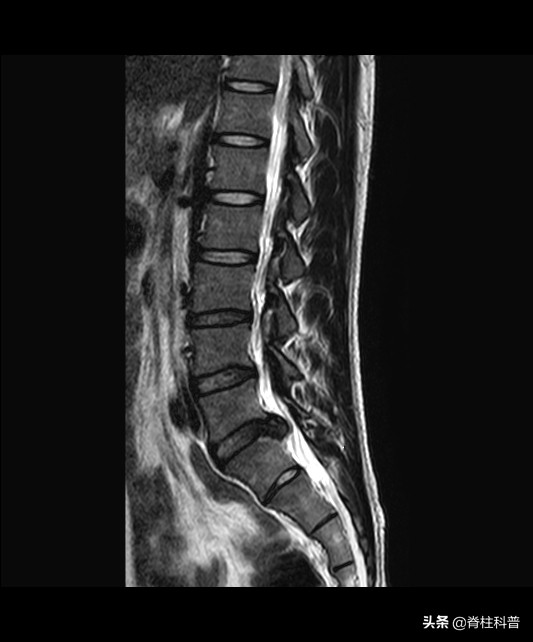 腰椎间盘突出拍x光还是做磁共振,腰椎间盘突出要做核磁还是ct