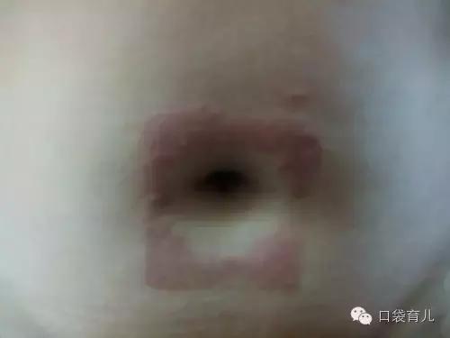 肚脐到底通向哪儿?宝宝“肚脐贴”为什么有“神效”?