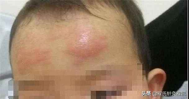 8个月宝宝发烧退热贴贴哪里,儿童发烧贴退热贴有没有用