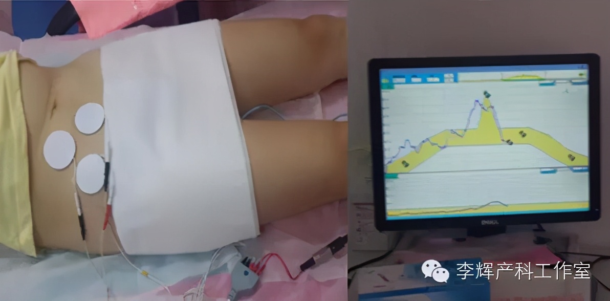 顺产后42天复查建议盆底康复治疗,产后42天复查医生要求做盆底康复