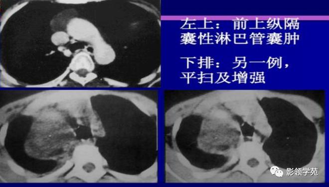 纵隔和肾上腺恶性肿瘤,纵隔性肿瘤位置图