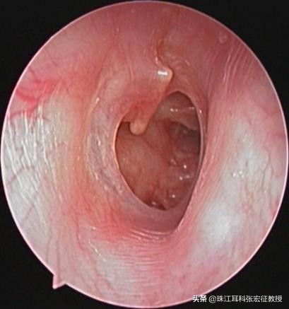 鼓膜穿孔不补会破得越来越大吗,鼓膜穿孔修复手术多少钱