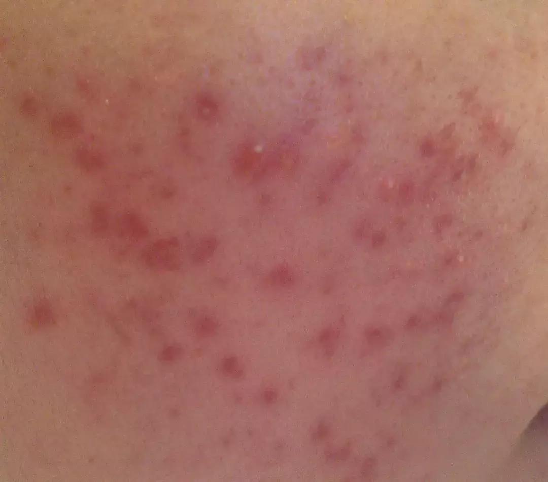 痘印祛痘药膏,痘印去除护肤品