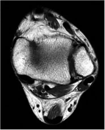 踝关节撞击症问诊,踝关节内侧撞击综合症位置图