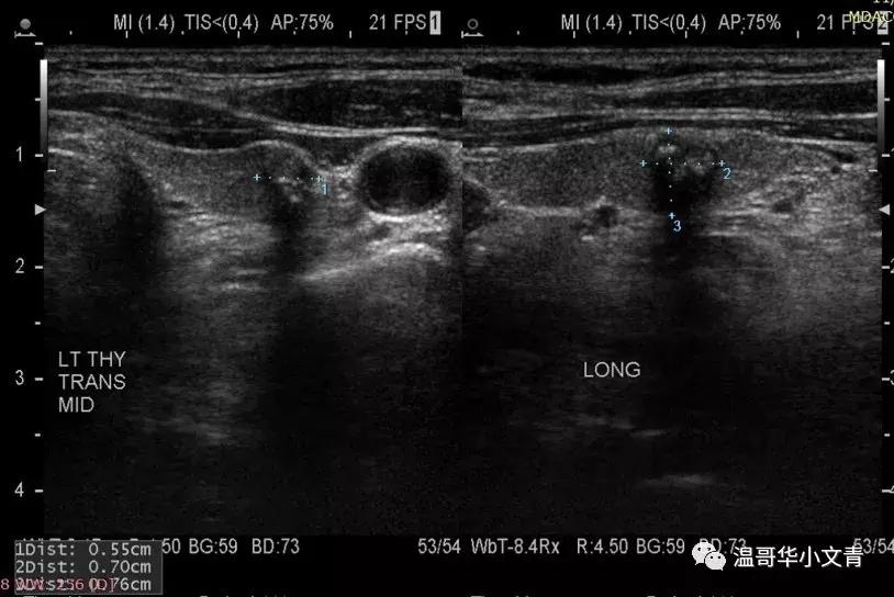 甲状腺癌治疗最好的医院,甲状腺癌的中医治疗方法
