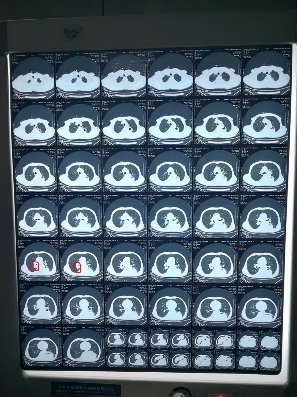 肺癌4期怎么提高生活质量,肺癌晚期怎么实现带瘤长期生存