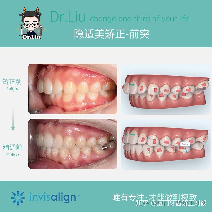 正畸临床拔牙矫治,拔牙正畸矫正嘴凸案例