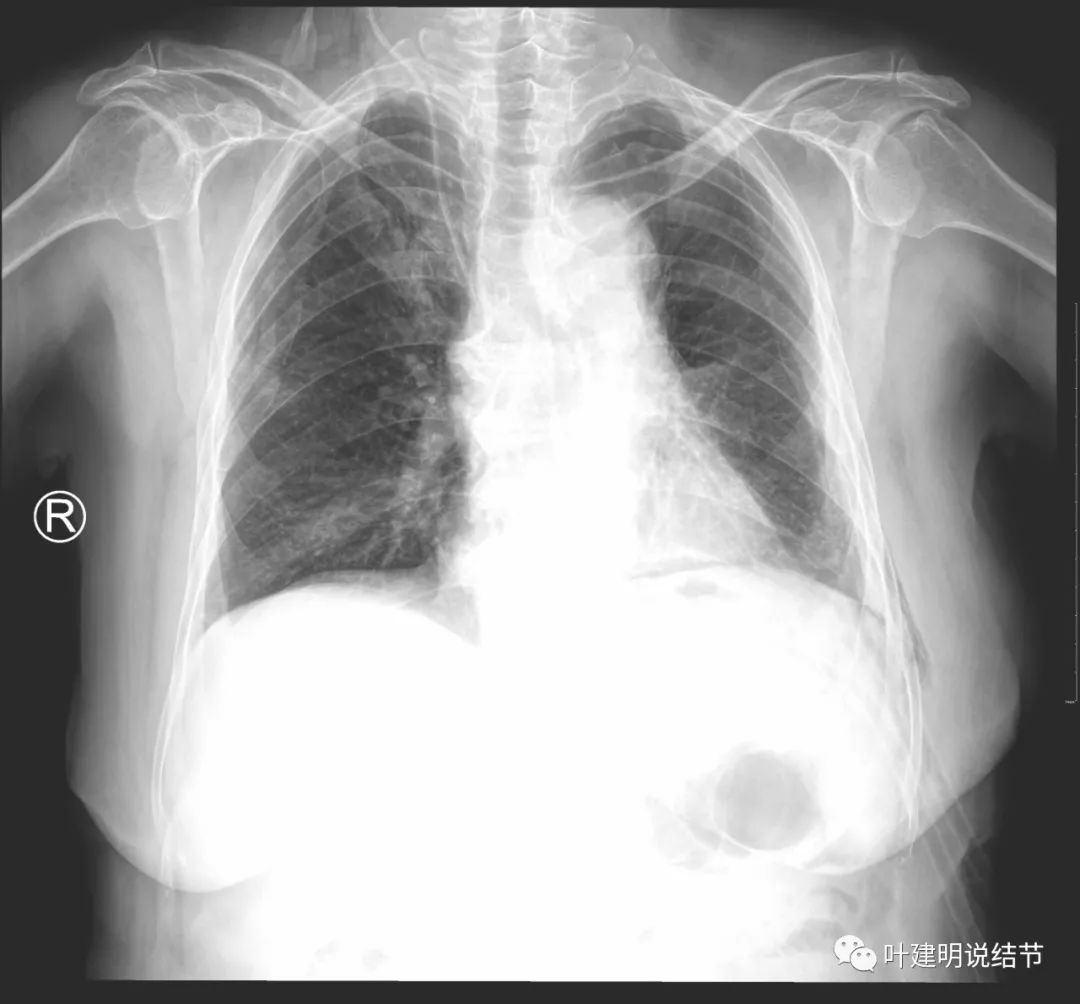 中央型肺癌手术前辅助治疗,中央型肺癌治疗后活过10年的病例