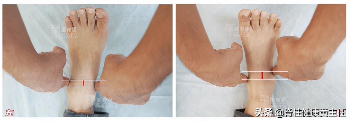 脚踝扭伤大半年还隐隐作痛，应该怎样处理？