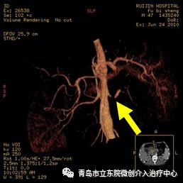 讲述一位高血压患者治愈经历,难治性高血压诊治图解