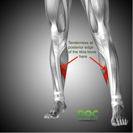 跑者小腿内侧痛,大神级跑者小腿