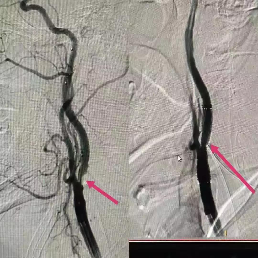 血管狭窄百分之五十吃药控制病情,血管狭窄有办法逆转吗视频