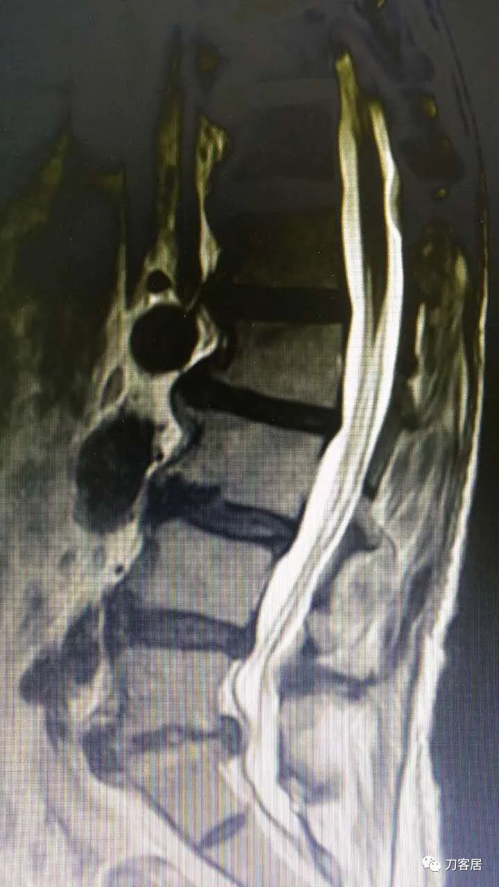 腰椎手术切掉棘突,腰突微创后出血肿
