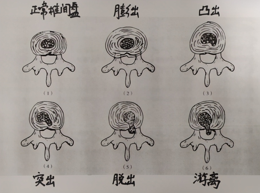 天天吊单杠真的有用吗,坚持吊单杠的危害