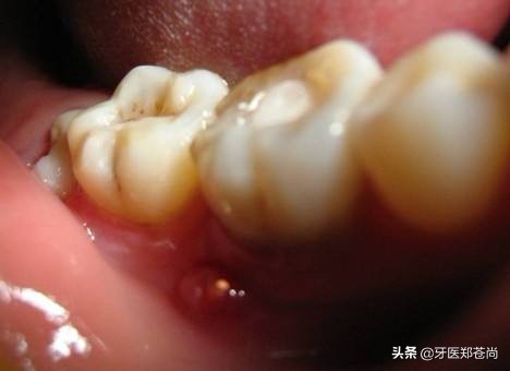 上面智齿长歪向脸颊好不好拔,智齿长歪了拔了多少钱