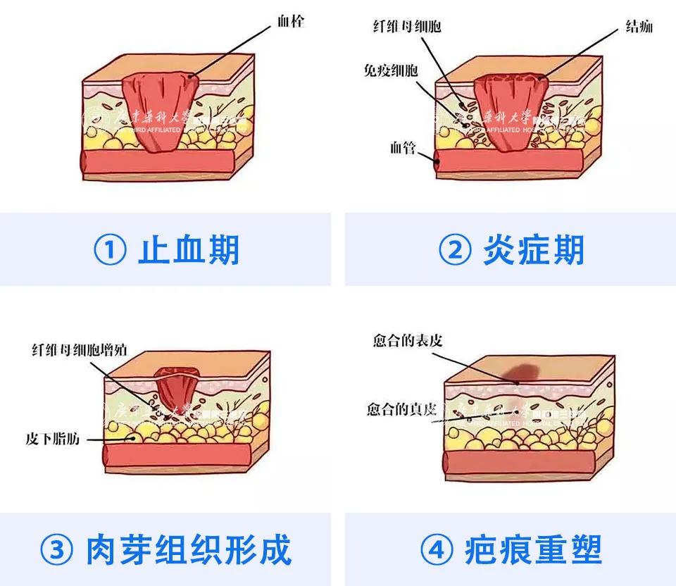 大葱是发物吗对伤口愈合有影响吗,疤痕饮食应注意什么