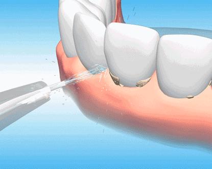 洗牙喷砂体验,洗牙历程