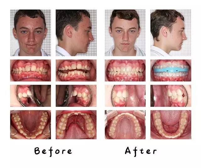 mrc矫正器小孩子晚上不愿意咬,mrc儿童牙齿矫正