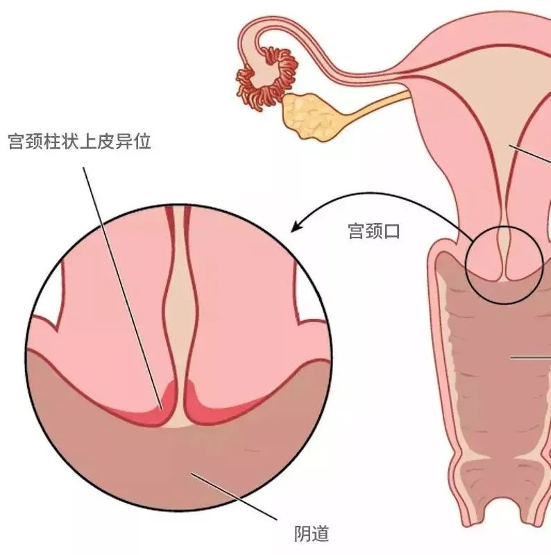 大夫说宫颈烂得很厉害,25岁女性宫颈烂了