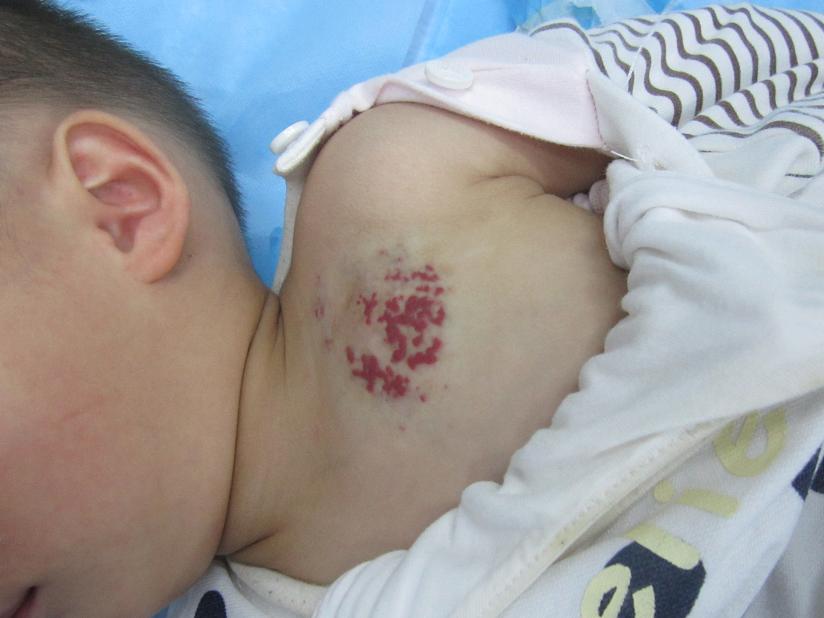 2岁女儿血管瘤,2岁小女孩肝血管瘤