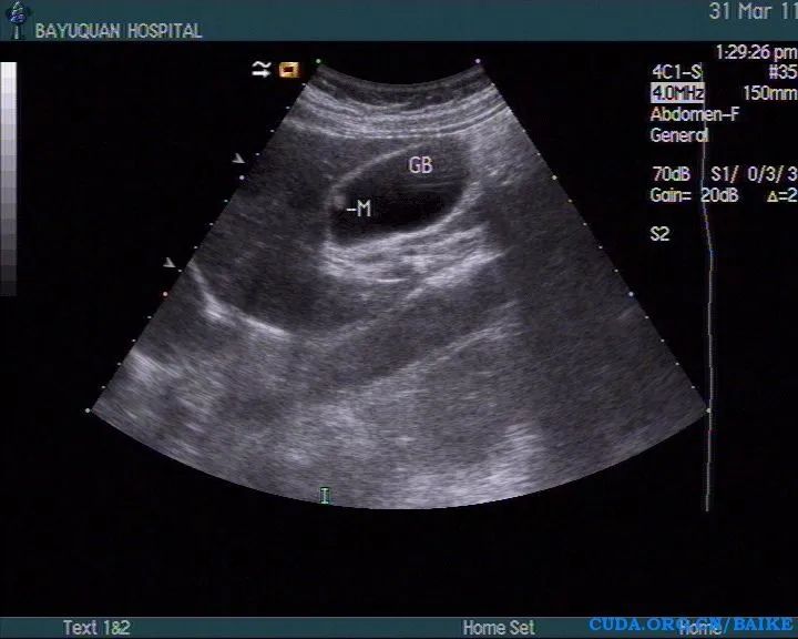 多发性胆囊息肉病,胆固醇沉积和胆囊息肉是一种病