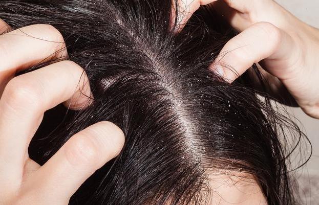 头皮有这四个怪相，大多是螨虫正在堵塞毛囊，两招螨虫被清空