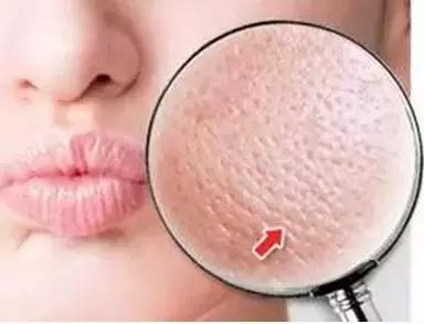 毛孔粗大怎么办什么方法有效,毛孔粗大怎么办怎样改善