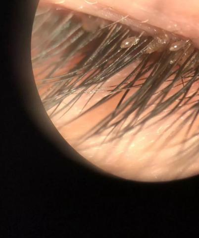 5岁女孩总揉眼睛,一检查取出20多只虱子……还在动