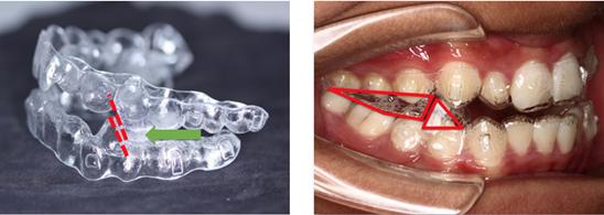 时代天使a6案例,时代天使隐形矫正牙齿