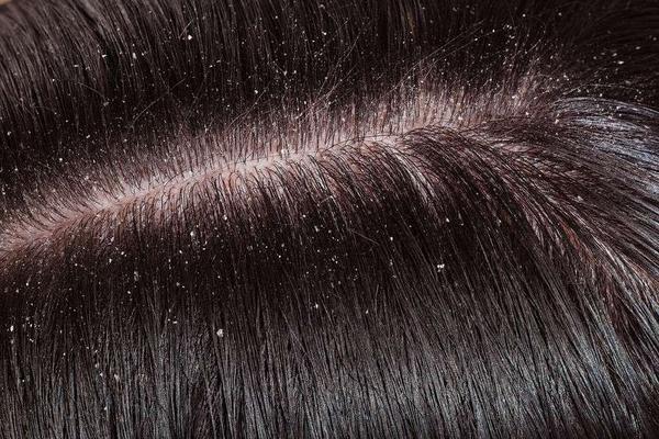 头发痒有头皮屑用什么方法去屑,头皮痒头皮屑去除最简单方法