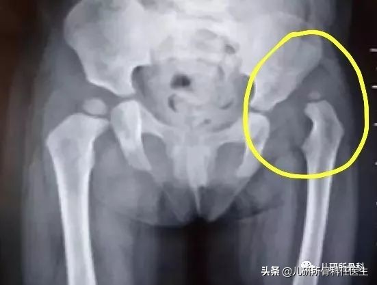 孩子臀纹不对称，看完门诊还是不明白？一次性解答你所有问题