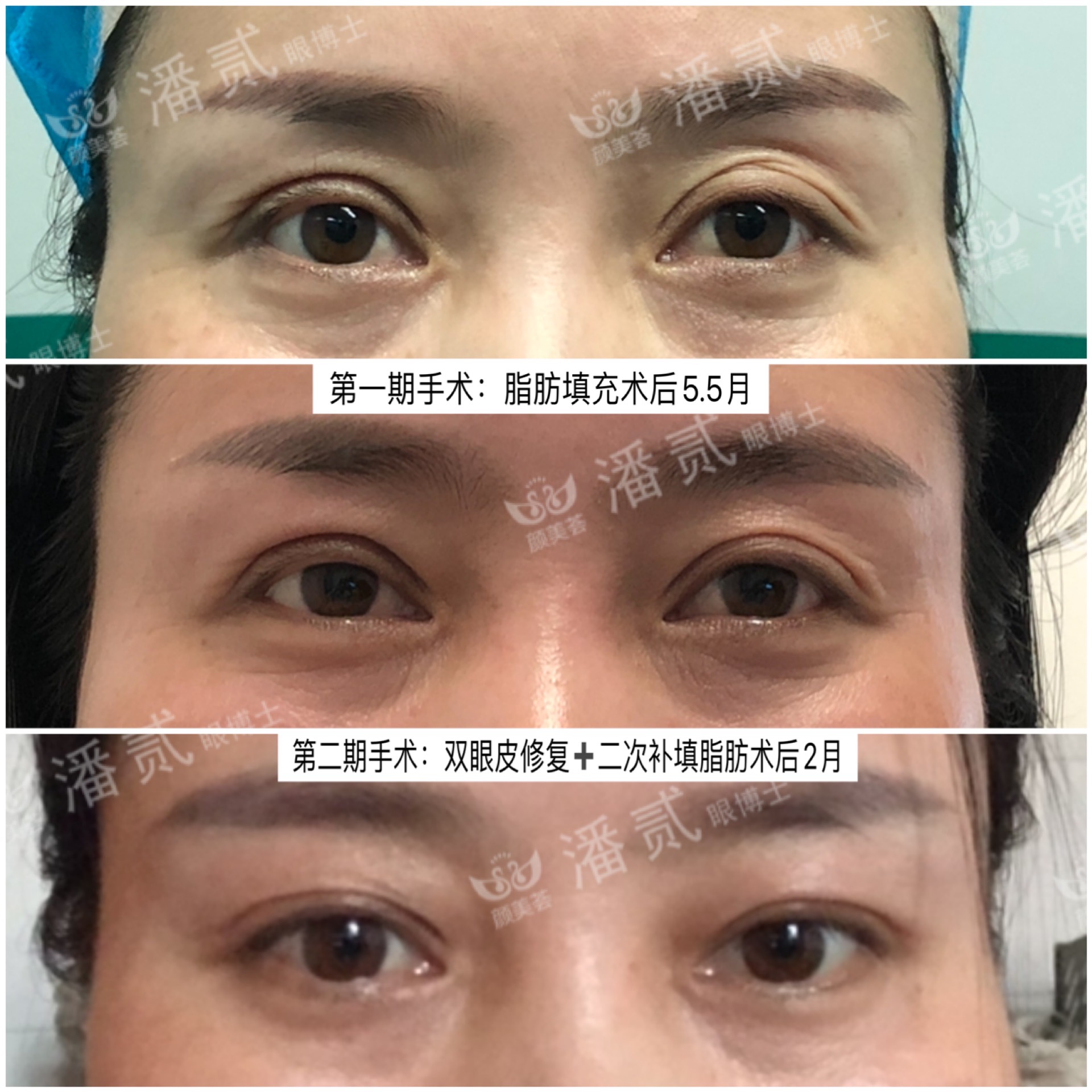 做双眼皮手术后眉毛会变吗,做双眼皮手术的疤痕会消失吗