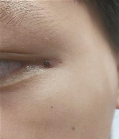 身上出现小黑点不疼也不痒,身上出现了黑点怎么回事