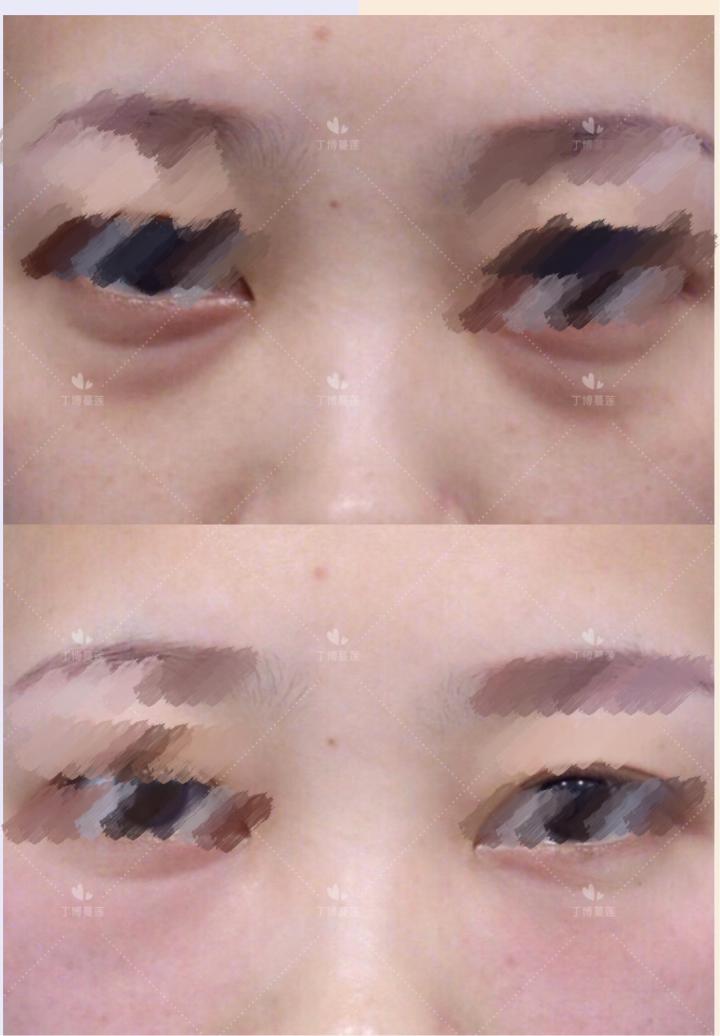 40岁去皱纹眼袋有效果吗,37岁眼袋有皱纹能去掉吗