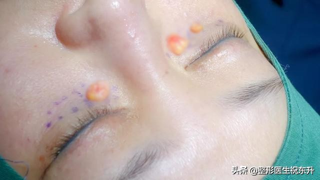 内切祛眼袋手术全过程,内切祛眼袋手术恢复记录