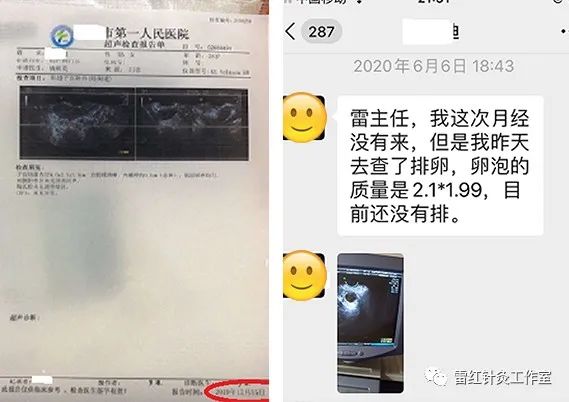 多囊卵巢综合征患者能自然怀孕吗？