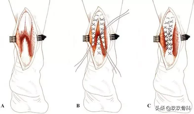 跟腱断裂的确诊方法,超详细跟腱断裂的诊断与治疗