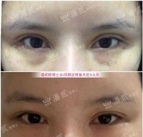 双眼皮手术后眼神凶狠是什么原因,双眼皮手术后显凶