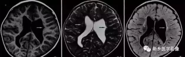 脑室影像学表现,脑室占位影像
