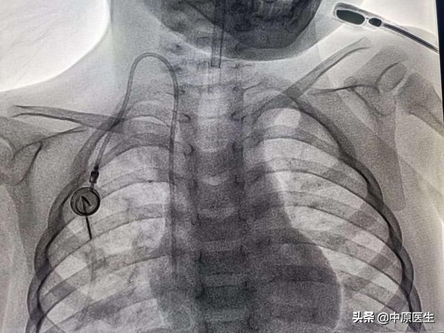 温馨的静脉输液港：为2岁化疗患儿提供长期静脉通道，不影响洗澡