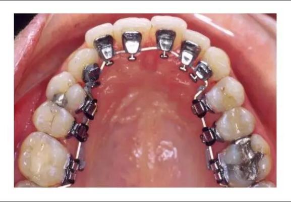 牙齿矫正有几种方式,牙齿矫正刷牙方式视频