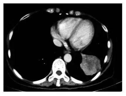 癌症疫苗将问世是真的吗,癌症疫苗或将问世