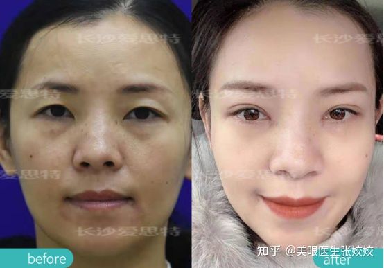 割双眼皮会影响运势吗,40岁割双眼皮效果图