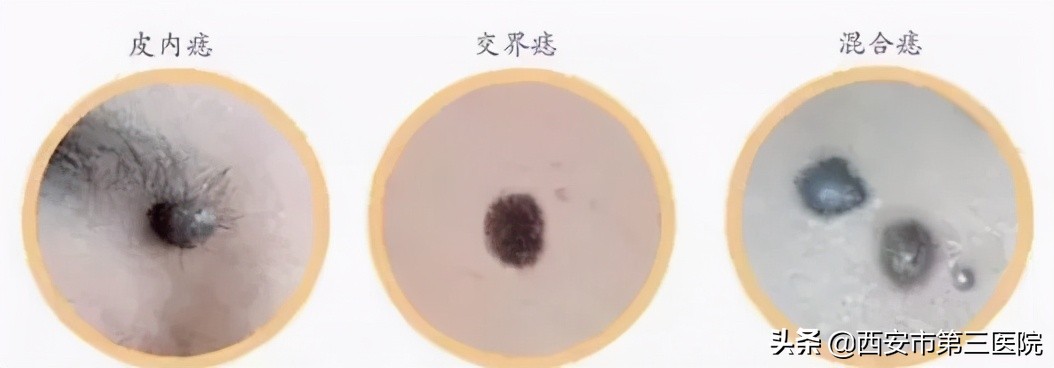 色素痣到底该不该去除,色素痣到底该不该去掉